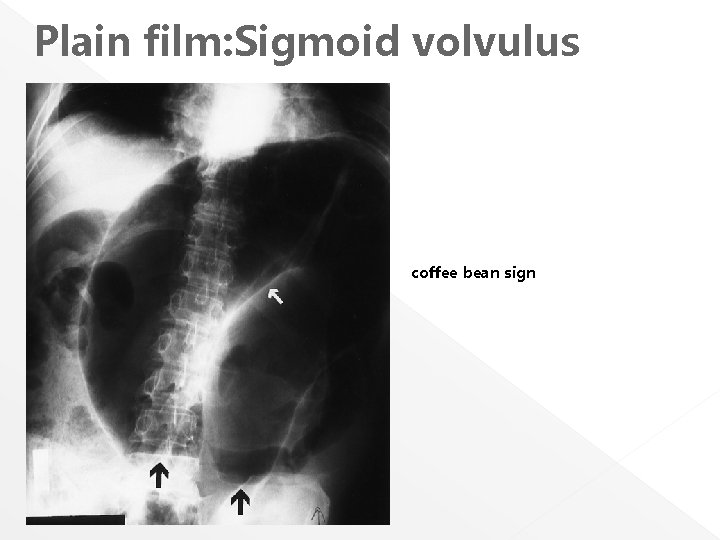 Plain film: Sigmoid volvulus coffee bean sign 