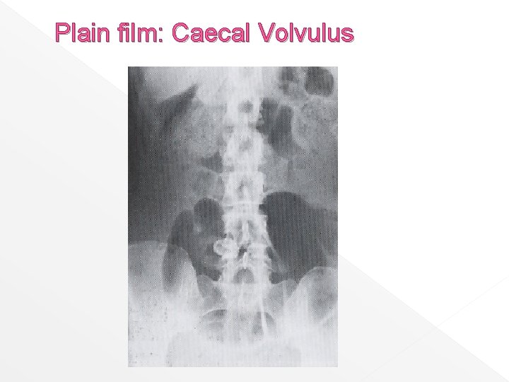 Plain film: Caecal Volvulus 