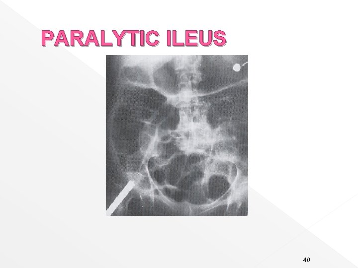 PARALYTIC ILEUS 40 