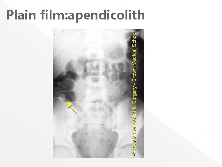 Plain film: apendicolith 
