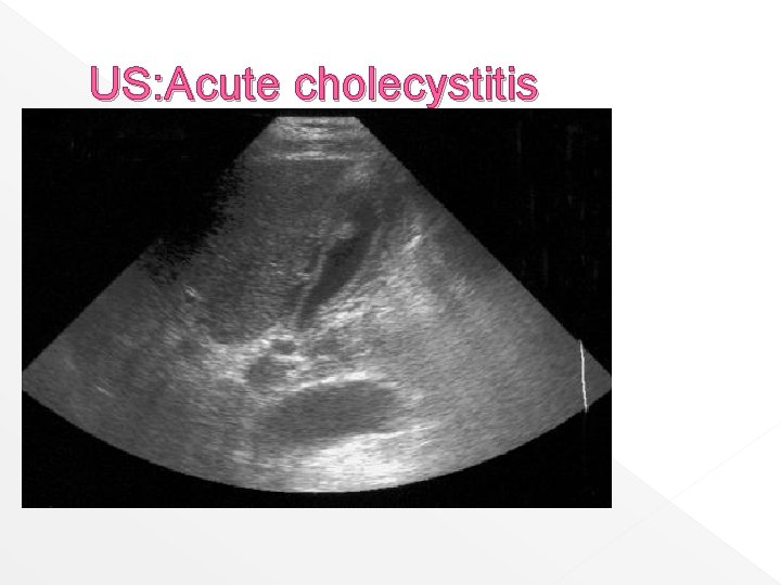 US: Acute cholecystitis 
