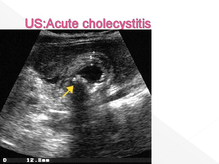 US: Acute cholecystitis 