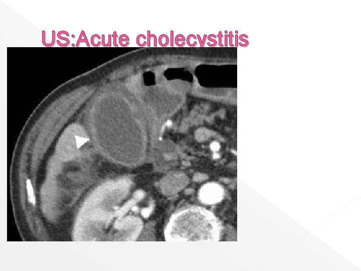 US: Acute cholecystitis 