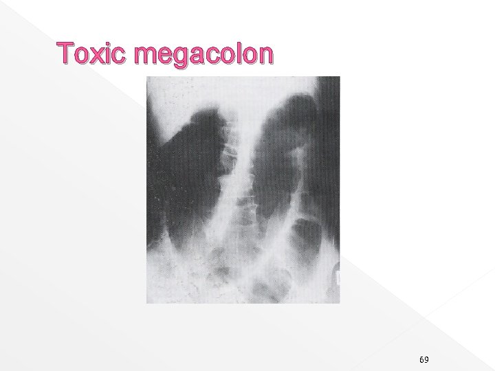 Toxic megacolon 69 