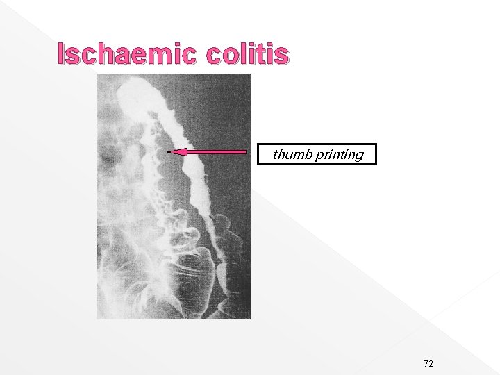 Ischaemic colitis thumb printing 72 