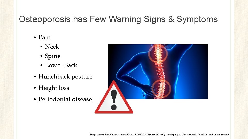 Osteoporosis has Few Warning Signs & Symptoms • Pain • Neck • Spine •