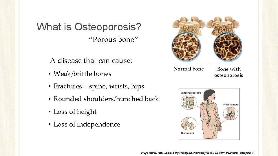 What is Osteoporosis? “Porous bone” A disease that can cause: Normal bone • Weak/brittle