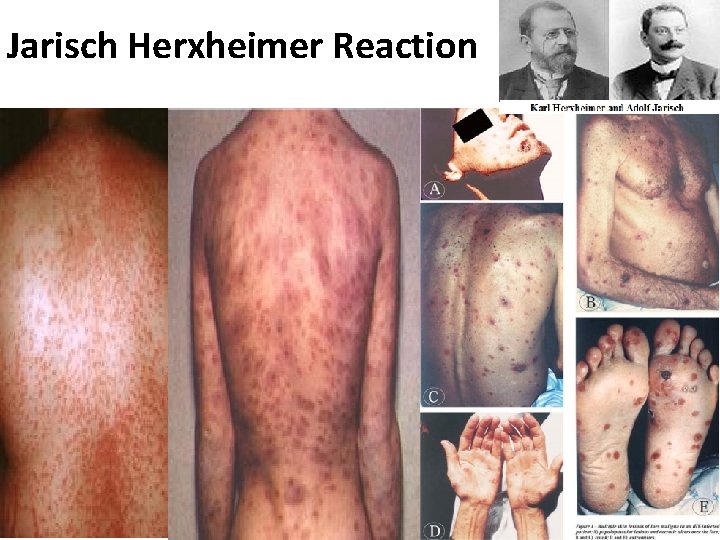 Jarisch Herxheimer Reaction 