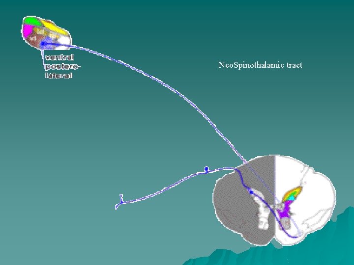 Neo. Spinothalamic tract 