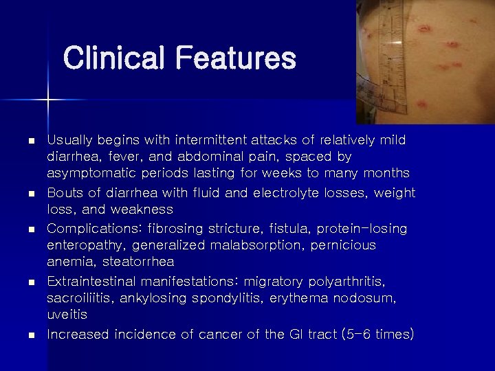 Clinical Features n n n Usually begins with intermittent attacks of relatively mild diarrhea,