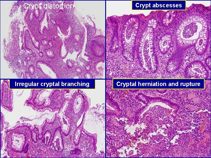 Distorted architecture Cryptcryptal distortion Crypt abscesses Irregular cryptal branching Cryptal herniation and rupture 