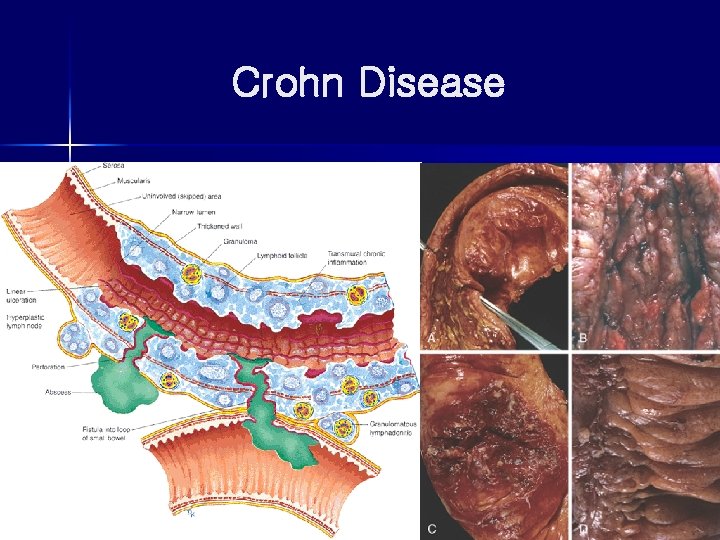 Crohn Disease 