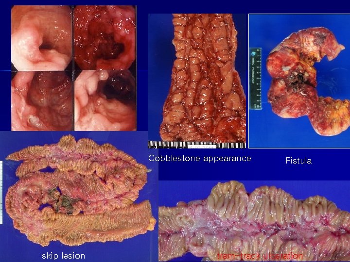 Cobblestone appearance skip lesion Fistula tram-track ulceration 