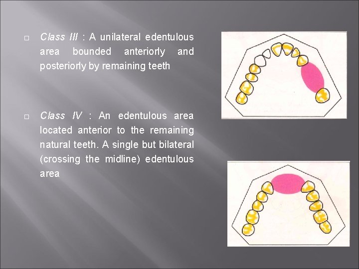  Class III : A unilateral edentulous area bounded anteriorly and posteriorly by remaining