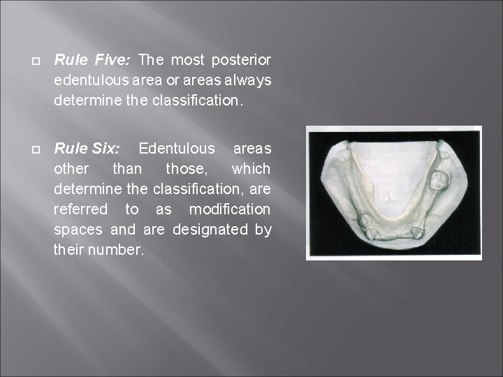  Rule Five: The most posterior edentulous area or areas always determine the classification.