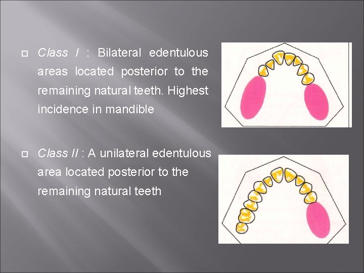  Class I : Bilateral edentulous areas located posterior to the remaining natural teeth.