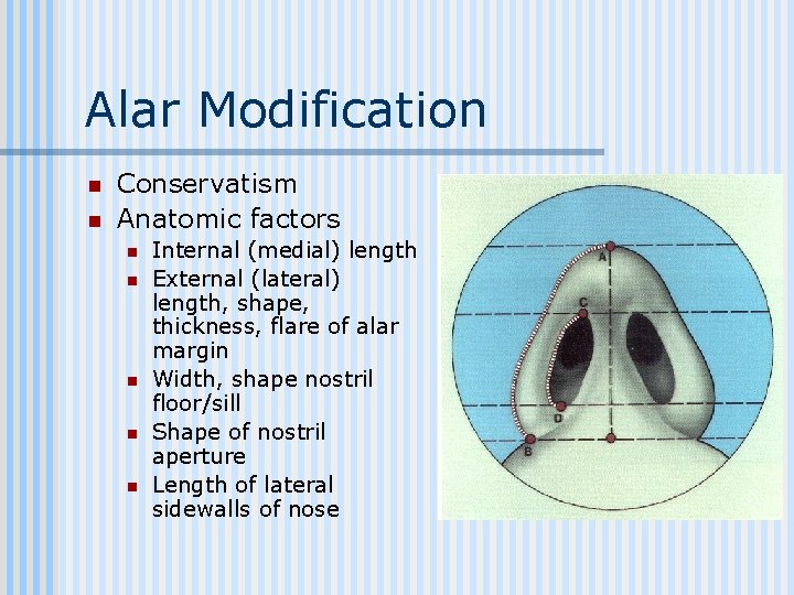 Alar Modification n n Conservatism Anatomic factors n n n Internal (medial) length External