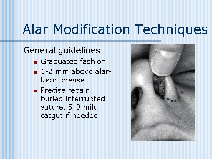 Alar Modification Techniques General guidelines n n n Graduated fashion 1 -2 mm above