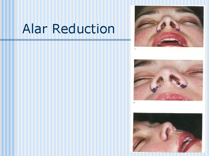 Alar Reduction 