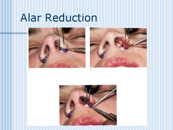 Alar Reduction 