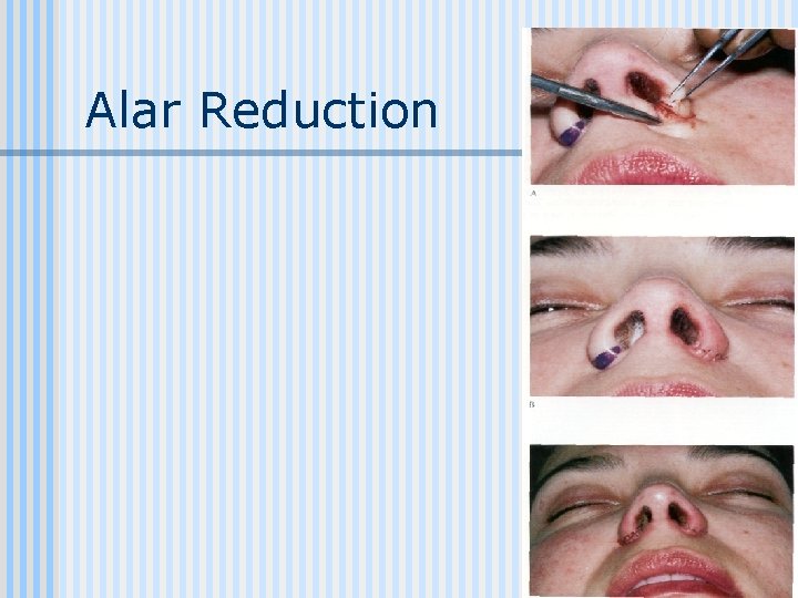 Alar Reduction 