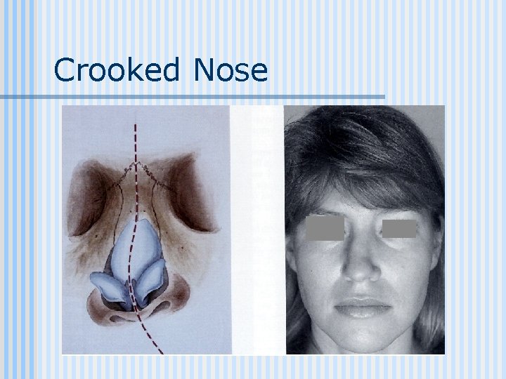 Crooked Nose 