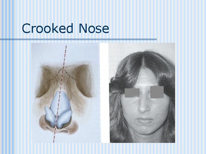 Crooked Nose 