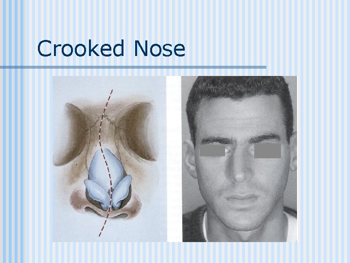 Crooked Nose 