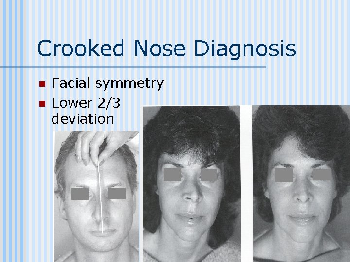 Crooked Nose Diagnosis n n Facial symmetry Lower 2/3 deviation 