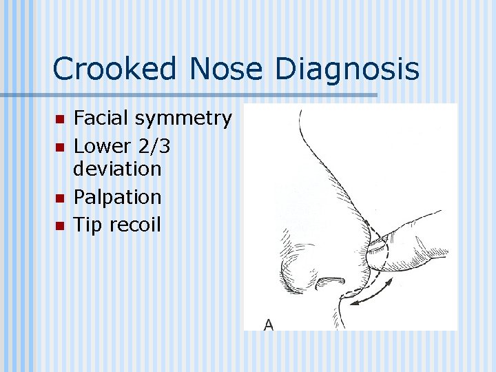 Crooked Nose Diagnosis n n Facial symmetry Lower 2/3 deviation Palpation Tip recoil 