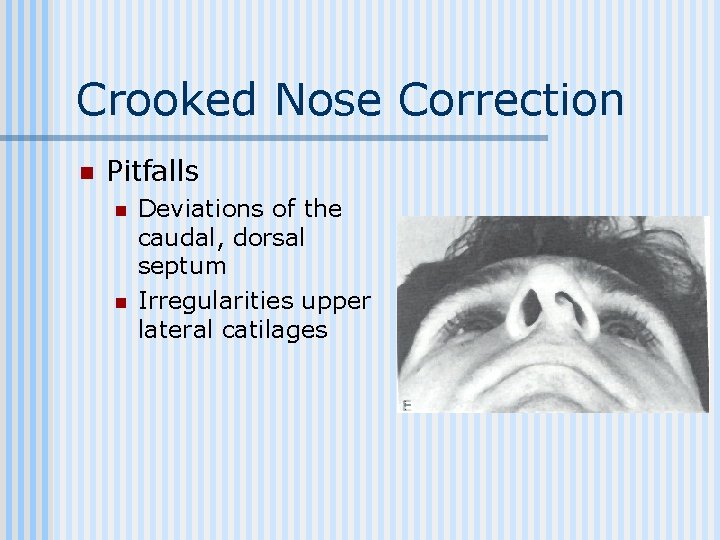 Crooked Nose Correction n Pitfalls n n Deviations of the caudal, dorsal septum Irregularities