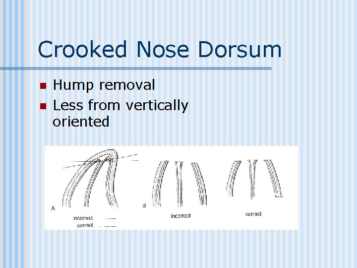 Crooked Nose Dorsum n n Hump removal Less from vertically oriented 