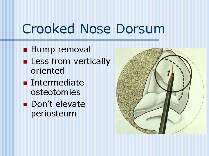 Crooked Nose Dorsum n n Hump removal Less from vertically oriented Intermediate osteotomies Don’t