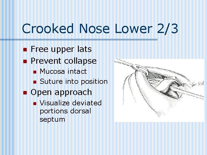 Crooked Nose Lower 2/3 n n Free upper lats Prevent collapse n n n