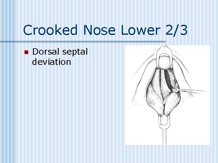 Crooked Nose Lower 2/3 n Dorsal septal deviation 