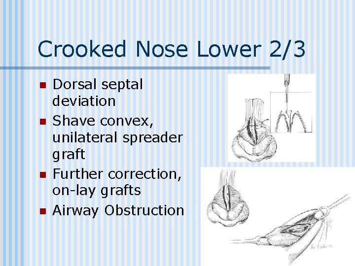 Crooked Nose Lower 2/3 n n Dorsal septal deviation Shave convex, unilateral spreader graft