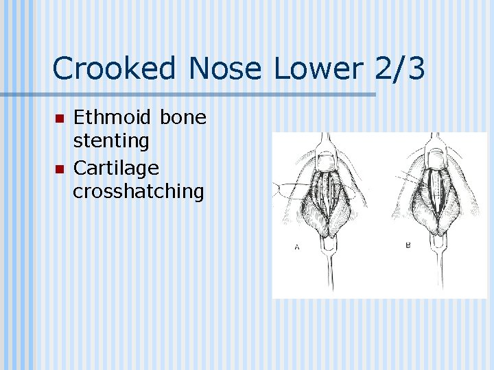 Crooked Nose Lower 2/3 n n Ethmoid bone stenting Cartilage crosshatching 