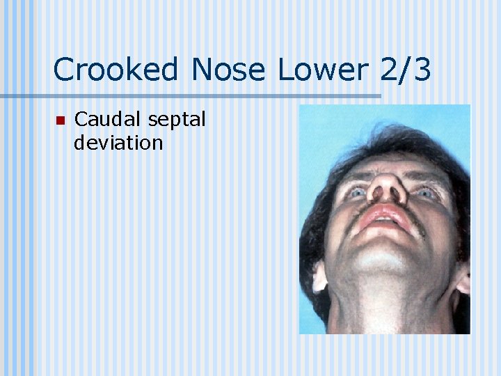 Crooked Nose Lower 2/3 n Caudal septal deviation 