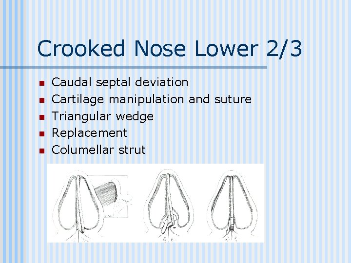 Crooked Nose Lower 2/3 n n n Caudal septal deviation Cartilage manipulation and suture