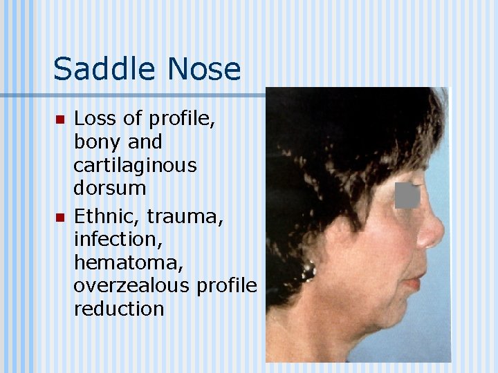 Saddle Nose n n Loss of profile, bony and cartilaginous dorsum Ethnic, trauma, infection,