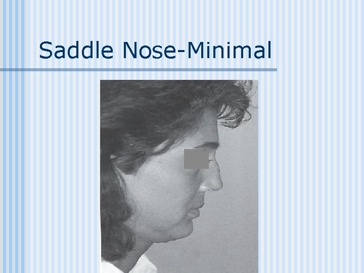 Saddle Nose-Minimal 