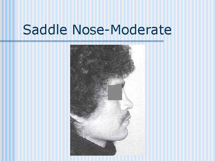 Saddle Nose-Moderate 