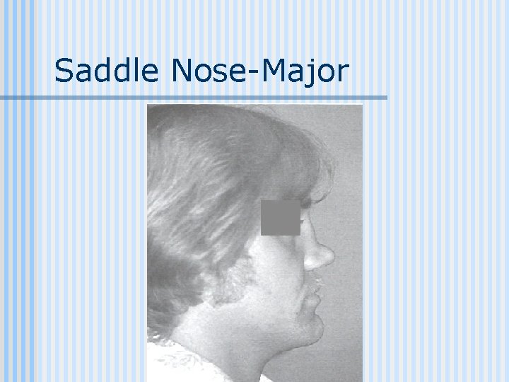 Saddle Nose-Major 