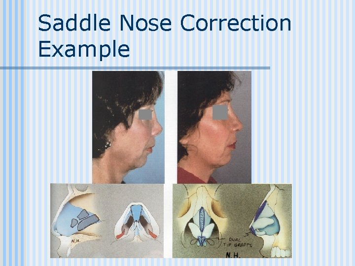 Saddle Nose Correction Example 
