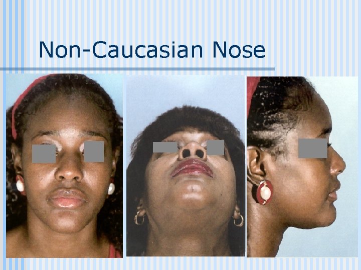 Non-Caucasian Nose 