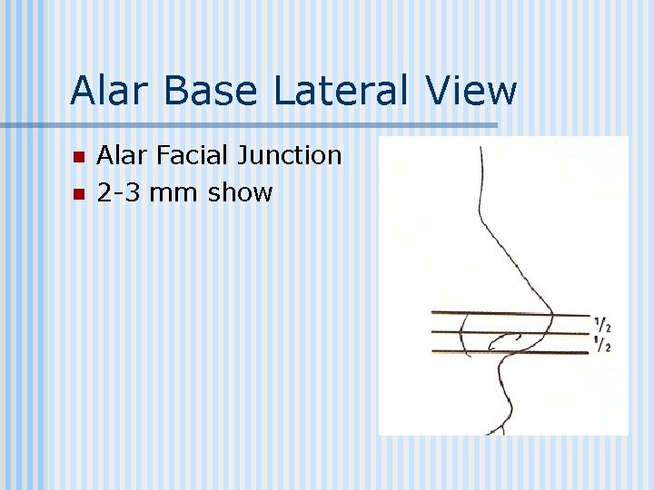 Alar Base Lateral View n n Alar Facial Junction 2 -3 mm show 
