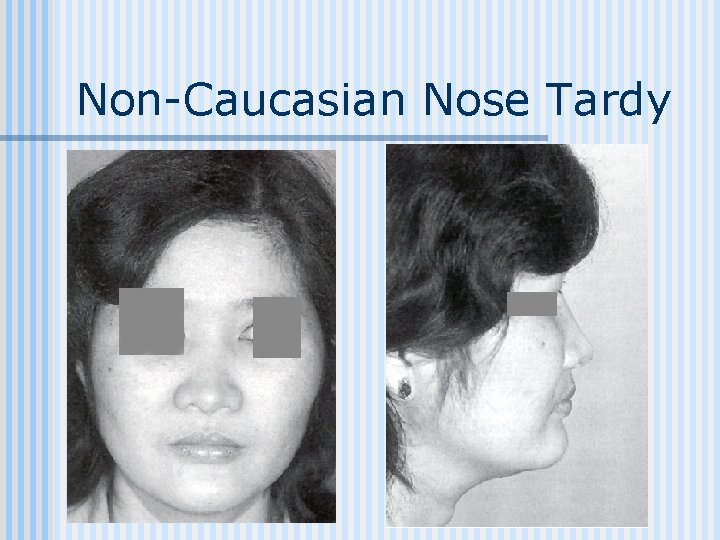 Non-Caucasian Nose Tardy 