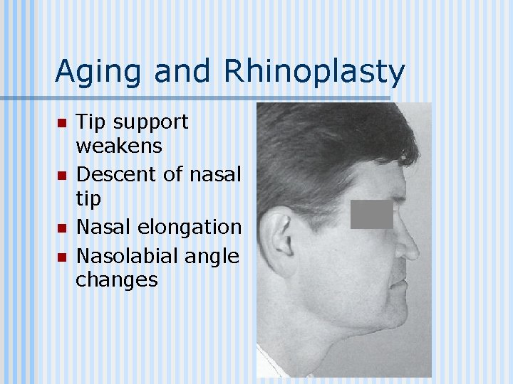 Aging and Rhinoplasty n n Tip support weakens Descent of nasal tip Nasal elongation