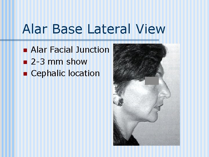 Alar Base Lateral View n n n Alar Facial Junction 2 -3 mm show