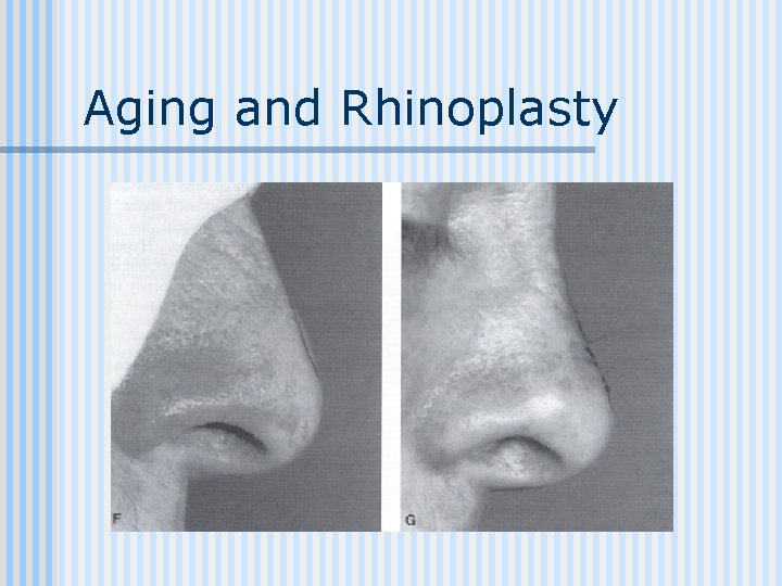 Aging and Rhinoplasty 